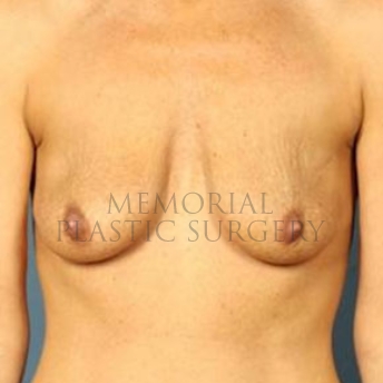 A front view before photo of patient 177 that underwent Breast Augmentation procedures at Memorial Plastic Surgery