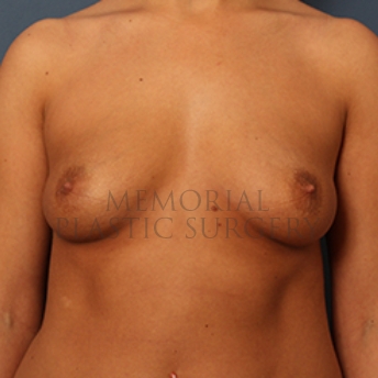 A front view before photo of patient 396 that underwent Breast Augmentation procedures at Memorial Plastic Surgery