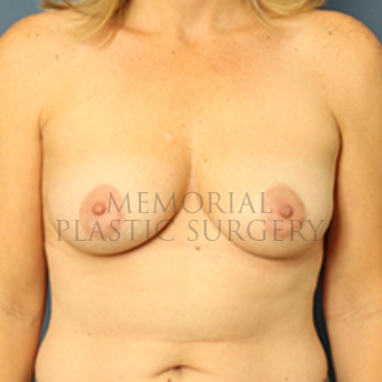 A front view before photo of patient 446 that underwent Breast Augmentation procedures at Memorial Plastic Surgery