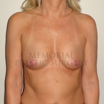 A front view before photo of patient 288 that underwent Breast Augmentation procedures at Memorial Plastic Surgery
