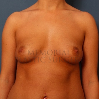 A front view before photo of patient 99 that underwent Breast Augmentation procedures at Memorial Plastic Surgery