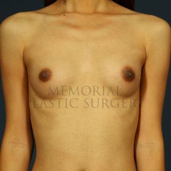 A front view before photo of patient 156 that underwent Breast Augmentation procedures at Memorial Plastic Surgery