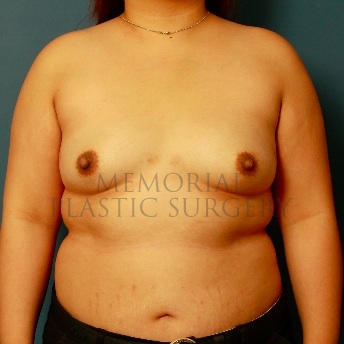 A front view before photo of patient 111 that underwent Breast Augmentation procedures at Memorial Plastic Surgery