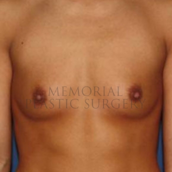 A front view before photo of patient 172 that underwent Breast Augmentation procedures at Memorial Plastic Surgery