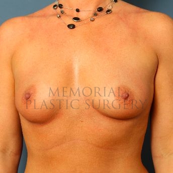 A front view before photo of patient 167 that underwent Breast Augmentation procedures at Memorial Plastic Surgery