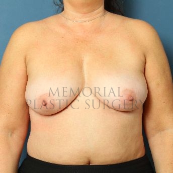 A front view before photo of patient 141 that underwent Breast Augmentation procedures at Memorial Plastic Surgery