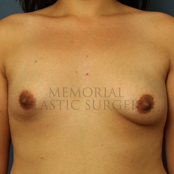 A front view before photo of patient 251 that underwent Breast Augmentation procedures at Memorial Plastic Surgery