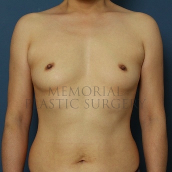 A front view before photo of patient 69 that underwent Breast Augmentation procedures at Memorial Plastic Surgery