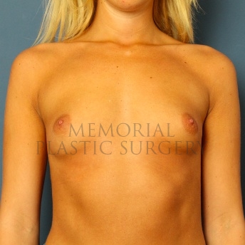 A front view before photo of patient 78 that underwent Breast Augmentation procedures at Memorial Plastic Surgery