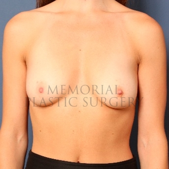 A front view before photo of patient 105 that underwent Breast Augmentation procedures at Memorial Plastic Surgery
