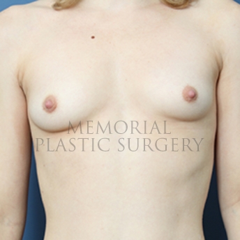 A front view before photo of patient 372 that underwent Breast Augmentation procedures at Memorial Plastic Surgery