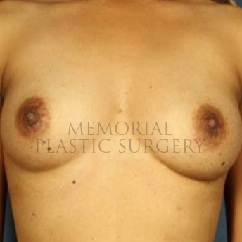 A front view before photo of patient 182 that underwent Breast Augmentation procedures at Memorial Plastic Surgery
