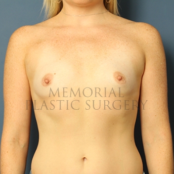 A front view before photo of patient 289 that underwent Breast Augmentation procedures at Memorial Plastic Surgery
