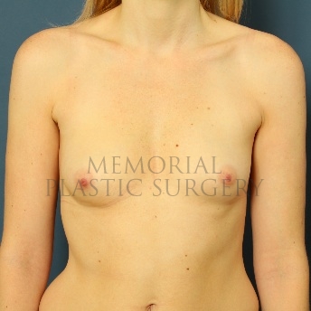 A front view before photo of patient 90 that underwent Breast Augmentation procedures at Memorial Plastic Surgery