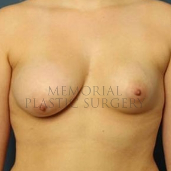 A front view before photo of patient 169 that underwent Breast Augmentation procedures at Memorial Plastic Surgery