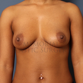A front view before photo of patient 355 that underwent Breast Augmentation procedures at Memorial Plastic Surgery