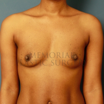 A front view before photo of patient 427 that underwent Breast Augmentation procedures at Memorial Plastic Surgery