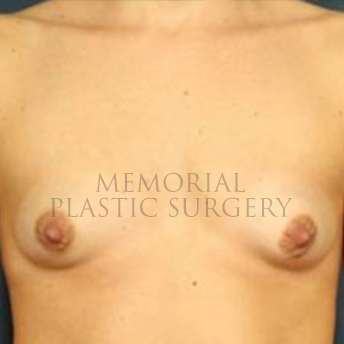 A front view before photo of patient 184 that underwent Breast Augmentation procedures at Memorial Plastic Surgery