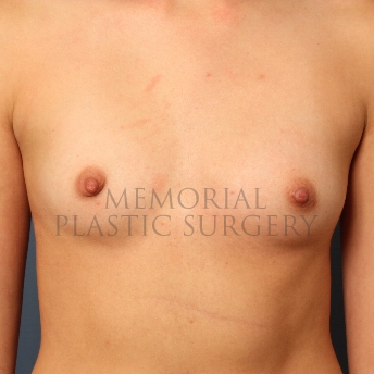 A front view before photo of patient 415 that underwent Breast Augmentation procedures at Memorial Plastic Surgery