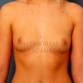 A front view before photo of patient 104 that underwent Breast Augmentation procedures at Memorial Plastic Surgery