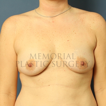A front view before photo of patient 286 that underwent Breast Augmentation procedures at Memorial Plastic Surgery