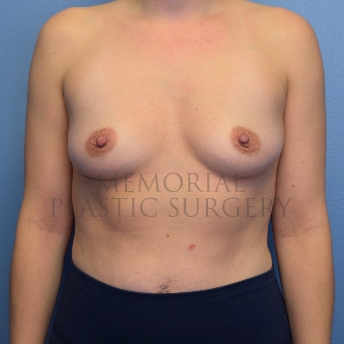 A front view before photo of patient 4101 that underwent Breast Augmentation procedures at Memorial Plastic Surgery