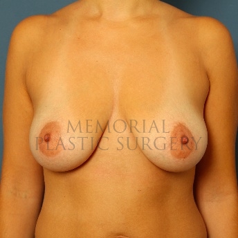 A front view before photo of patient 102 that underwent Breast Augmentation procedures at Memorial Plastic Surgery
