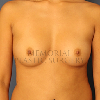 A front view before photo of patient 398 that underwent Breast Augmentation procedures at Memorial Plastic Surgery