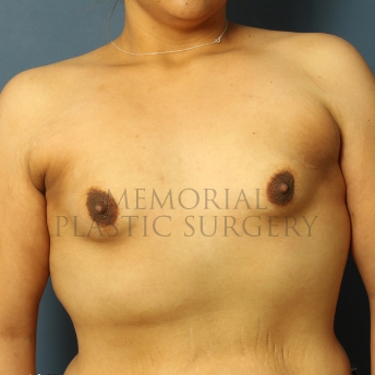 A front view before photo of patient 439 that underwent Breast Augmentation procedures at Memorial Plastic Surgery