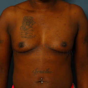 A front view before photo of patient 77 that underwent Breast Augmentation procedures at Memorial Plastic Surgery