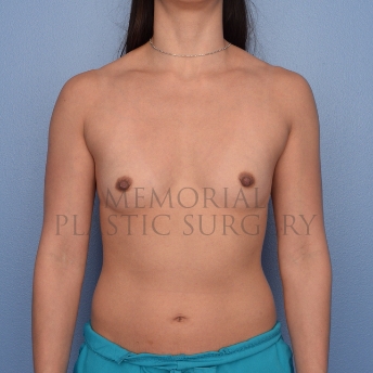 A front view before photo of patient 699 that underwent Breast Augmentation procedures at Memorial Plastic Surgery