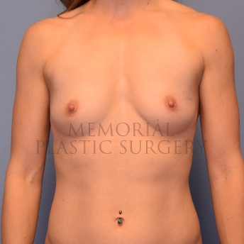 A front view before photo of patient 2420 that underwent Breast Augmentation procedures at Memorial Plastic Surgery