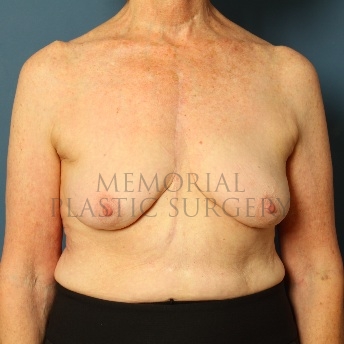A front view before photo of patient 72 that underwent Breast Augmentation procedures at Memorial Plastic Surgery