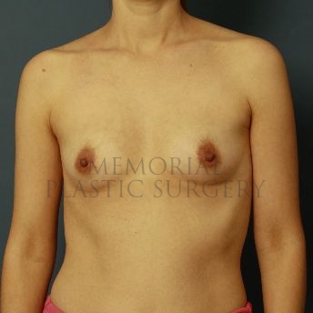 A front view before photo of patient 144 that underwent Breast Augmentation procedures at Memorial Plastic Surgery