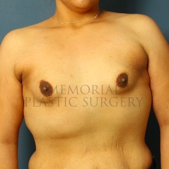 A front view before photo of patient 137 that underwent Breast Augmentation procedures at Memorial Plastic Surgery