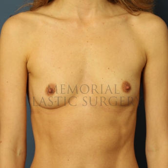 A front view before photo of patient 437 that underwent Breast Augmentation procedures at Memorial Plastic Surgery
