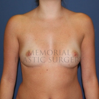A front view before photo of patient 94 that underwent Breast Augmentation procedures at Memorial Plastic Surgery