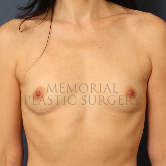 A front view before photo of patient 406 that underwent Breast Augmentation procedures at Memorial Plastic Surgery