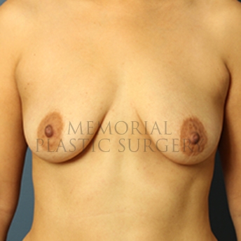 A front view before photo of patient 344 that underwent Breast Augmentation procedures at Memorial Plastic Surgery