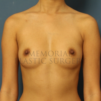 A front view before photo of patient 440 that underwent Breast Augmentation procedures at Memorial Plastic Surgery