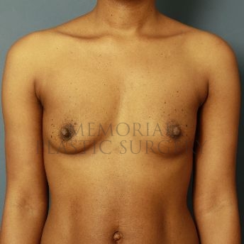 A front view before photo of patient 133 that underwent Breast Augmentation procedures at Memorial Plastic Surgery