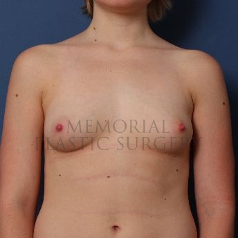 A front view before photo of patient 132 that underwent Breast Augmentation procedures at Memorial Plastic Surgery