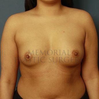 A front view before photo of patient 157 that underwent Breast Augmentation procedures at Memorial Plastic Surgery