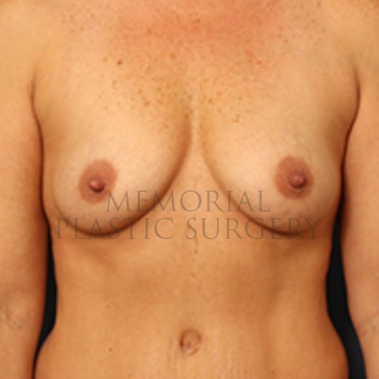A front view before photo of patient 352 that underwent Breast Augmentation procedures at Memorial Plastic Surgery