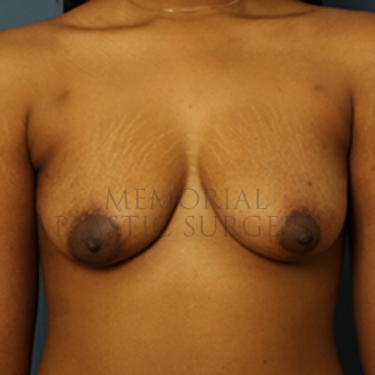 A front view before photo of patient 390 that underwent Breast Augmentation procedures at Memorial Plastic Surgery