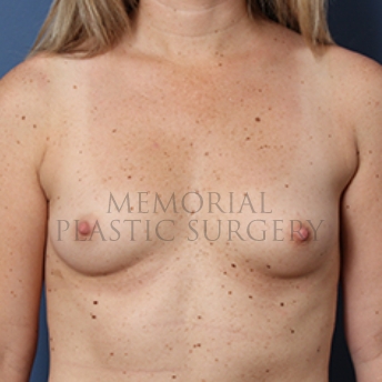 A front view before photo of patient 362 that underwent Breast Augmentation procedures at Memorial Plastic Surgery
