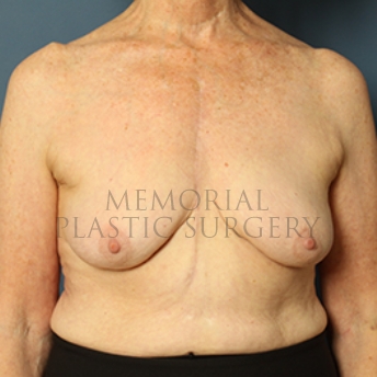 A front view before photo of patient 332 that underwent Breast Augmentation procedures at Memorial Plastic Surgery