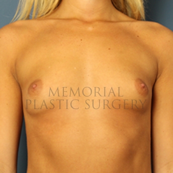 A front view before photo of patient 343 that underwent Breast Augmentation procedures at Memorial Plastic Surgery