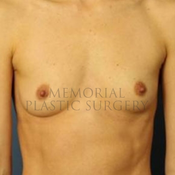 A front view before photo of patient 175 that underwent Breast Augmentation procedures at Memorial Plastic Surgery