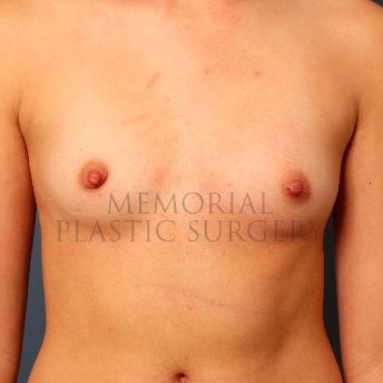 A front view before photo of patient 110 that underwent Breast Augmentation procedures at Memorial Plastic Surgery